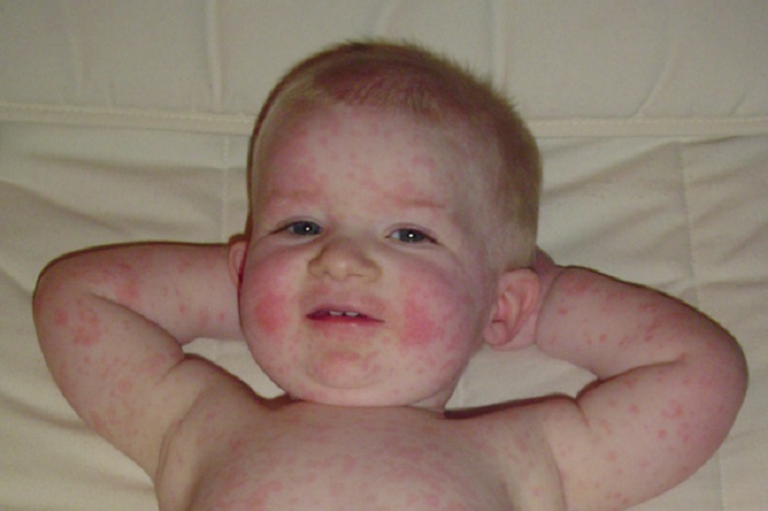 Erythème infectieux