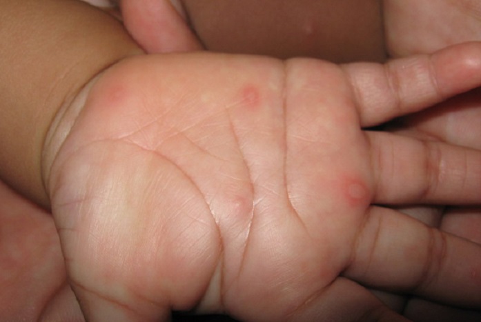 Syndrome pied-main-bouche