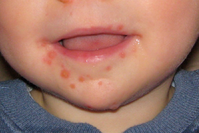 Syndrome pied-main-bouche